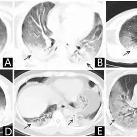 新冠肺炎的世界排名，新冠肺炎世界排位
